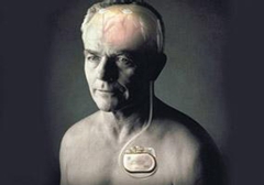 起搏器真的能治好帕金森病嗎？